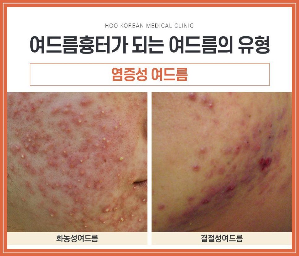 제천피부과 여드름흉터 치료 전 체크할 것들